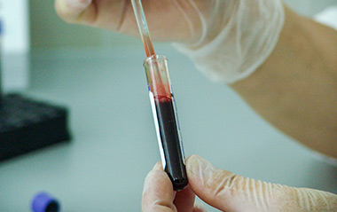 血HCG检查