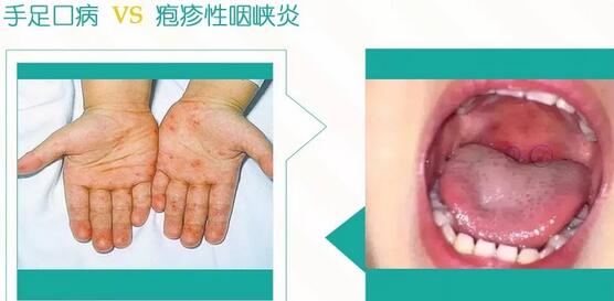 根据历年的发病规律, 5-7月是手足口病和疱疹性咽颊炎的高发期。 统计数据显示: 2010-2017年,我国手足口病年均报告病例206.7万例, 重症病例约13.5万例,死亡3153多人。 仅“手足口”病就够妈妈们闹心的了, 有的文章还说疱疹性咽颊炎比手足口病还重, 那就更加紧张起来。 也许有人疑惑,手足口病和疱疹性咽峡炎, 这两个听起来八竿子打不着的病, 为什么放在一起? 原因很简单, 人家是“表兄弟”,在长相、传染性等非常相似, 很容易被混淆。 那么如何区分二者? 今天我们就来扒一扒这对祸害宝宝们的“小强们”。 手足口病 高发季节:4~7月 传染性:较强 出疹特征:大米状的椭圆形白色水疱,周围有红晕,看起来比较干瘪,不痒。 出疹位置:多见于指腹、手掌心、脚掌心、口腔等部位,躯干很少。 疱疹性咽峡炎 高发季节:夏秋季节 传染性:较强 出疹特征:咽峡部黏膜长了灰白色的小疱疹或者浅表溃疡,会很痛,孩子不爱吃东西,流口水。 出疹位置:口腔内咽峡部,仅在口腔内。