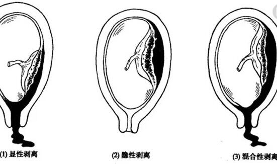 胎盘早剥产妇