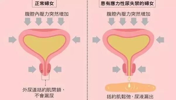 盆底障碍性疾病