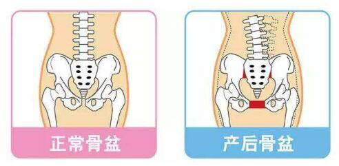 骨盆修复